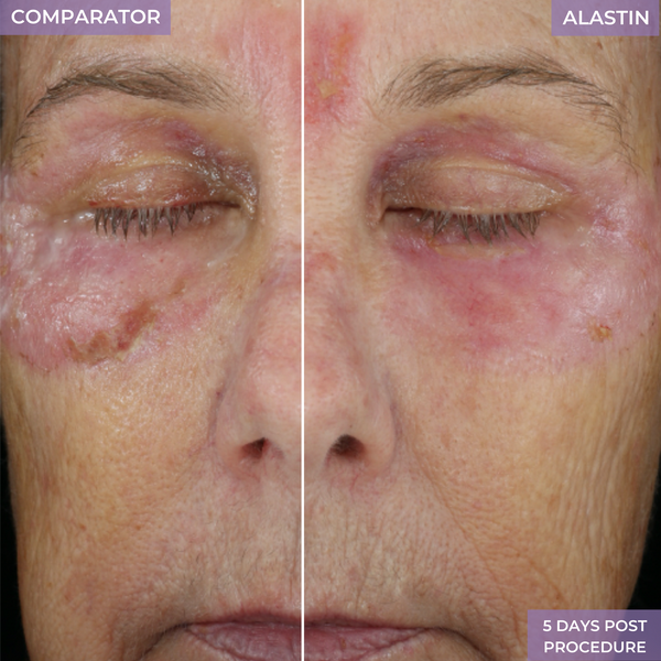 Improved Appearance of Skin 2 Weeks Following Laser Resurfacing