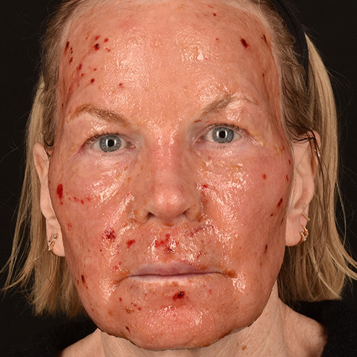 Ablative Laser & Regenerating Skin Nectar With TriHex+