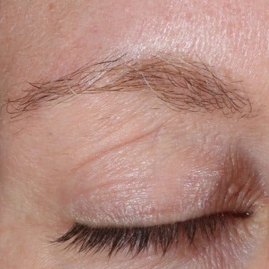 Improved Appearance of Wrinkles and Skin Texture On the Upper Eyelid