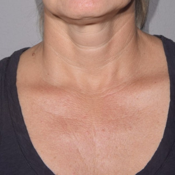 Improved Appearance Of Wrinkles on the Chest