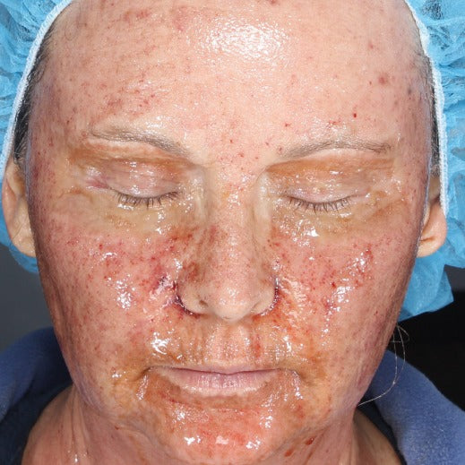 Reduced Recovery Time and Enhanced Outcomes Following Laser Resurfacing