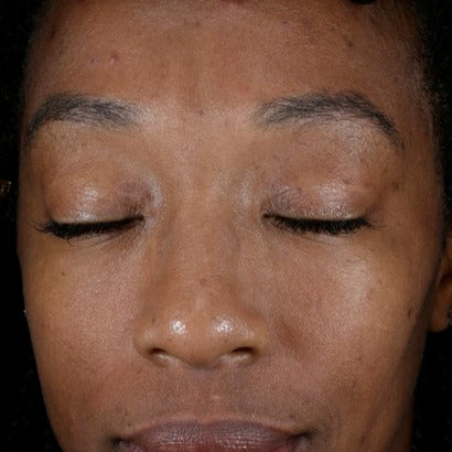 Improved Appearance of Pigmentation and Uneven Skin Tone