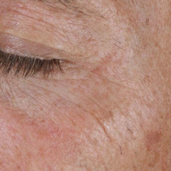 Improved Appearance of Wrinkles and Skin Texture Around the Eye