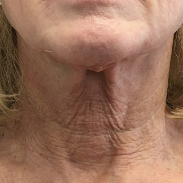 Improved Appearance of Crepey Skin and Wrinkles