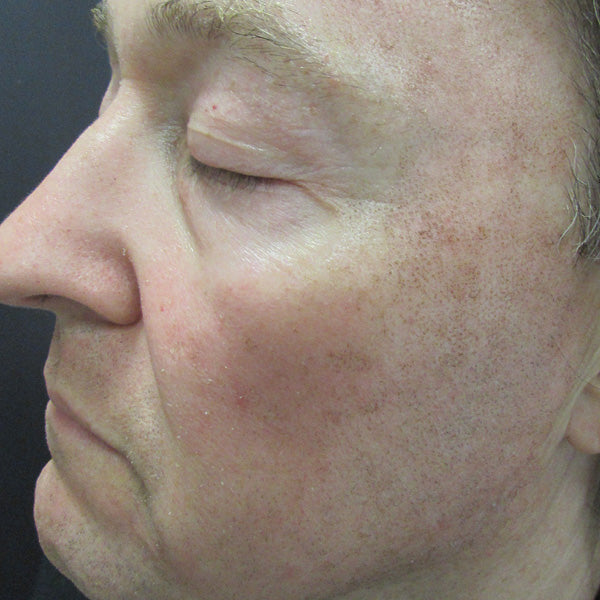 Reduced Recovery Time and Enhanced Outcomes Following Laser Resurfacing