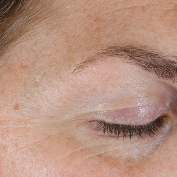 Improved Appearance of Skin Tone and Texture