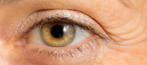 How to Get Rid of Crow’s Feet Wrinkles Around the Eyes