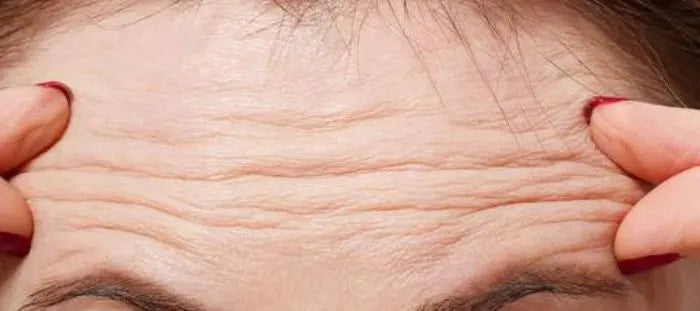 Woman shows off her forehead wrinkles