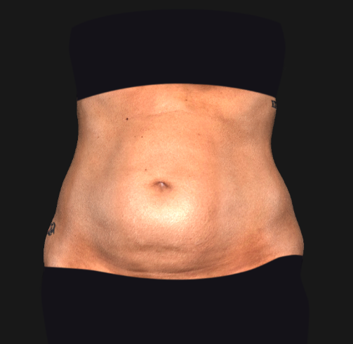CoolSculpting Before and After Picture of Back Fat and Stomach -  Connecticut Skin Institute