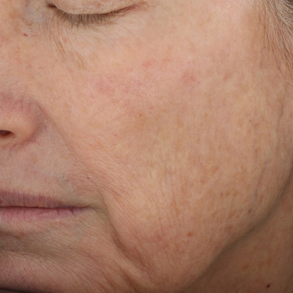 VISIBLE IMPROVEMENT IN THE APPEARANCE OF SURFACE ROUGHNESS, REDNESS, FINE LINES AND WRINKLES, SKIN DULLNESS AND LOSS OF VOLUME.
