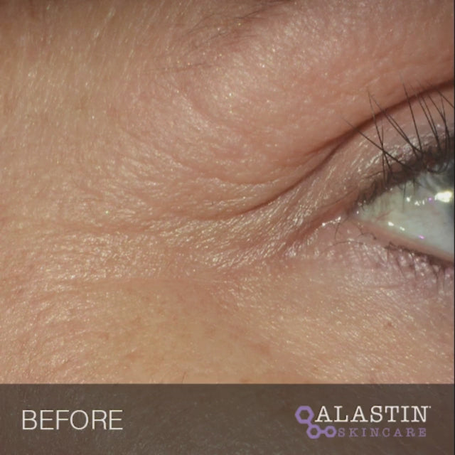 Restorative Eye Treatment with TriHex Technology ALASTIN Skincare